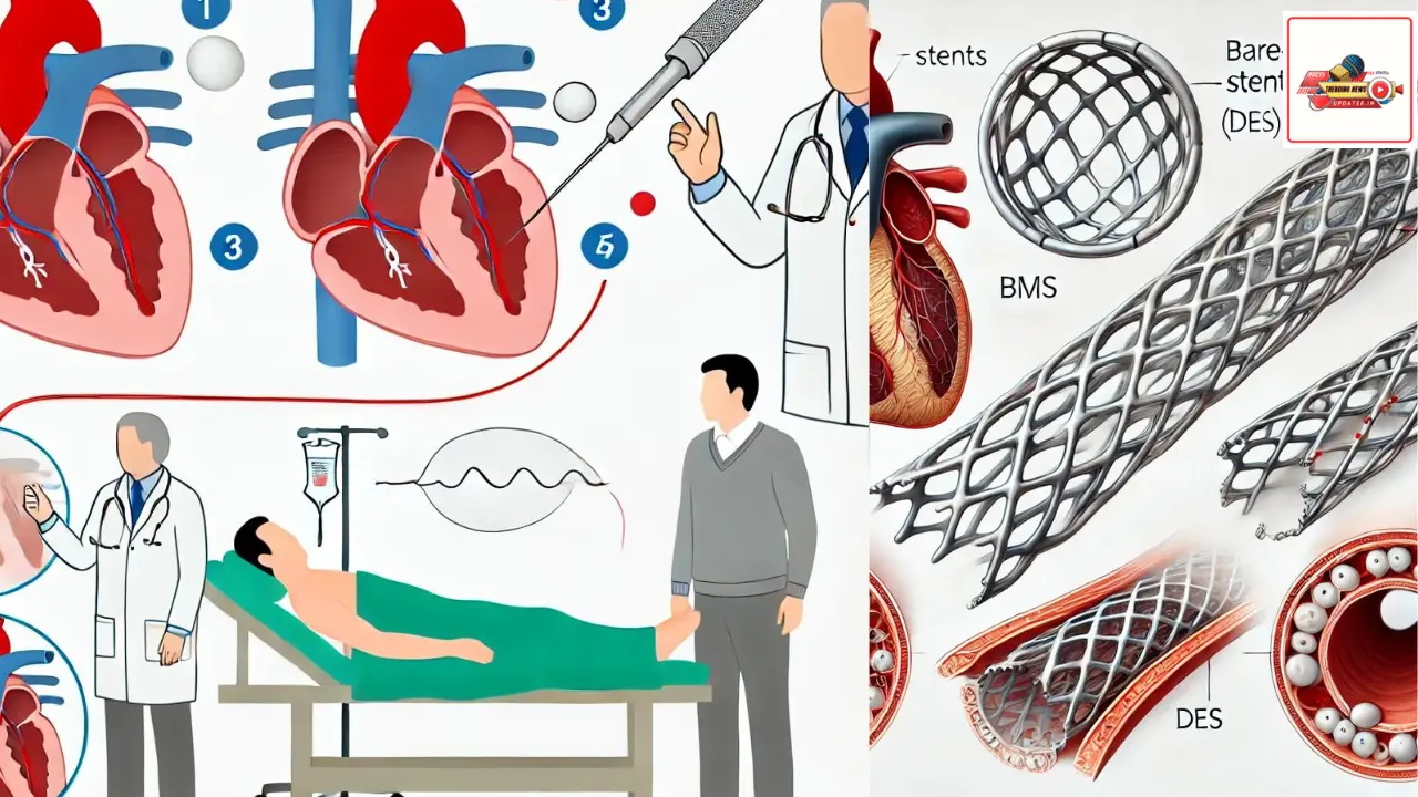 stent placement